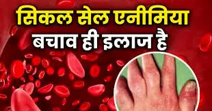 सिर्फ बीमारी नहीं, एक सामाजिक आपातकाल है सिकल सेल सिर्फ बीमारी नहीं, एक सामाजिक आपातकाल है सिकल सेल