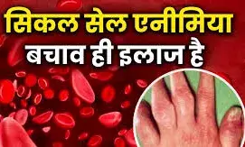 सिर्फ बीमारी नहीं, एक सामाजिक आपातकाल है सिकल सेल